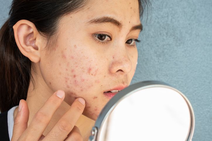Acne Treatment, There's No Better Way!