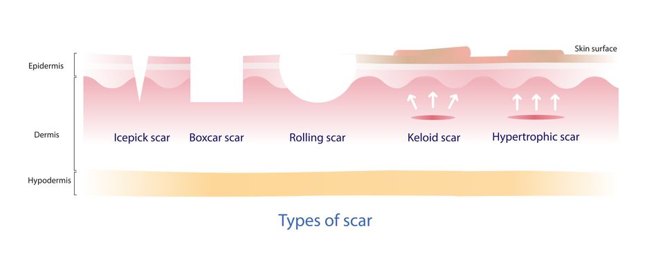 Our Ultimate Acne Scars Guide Is For You If You Are Looking For The