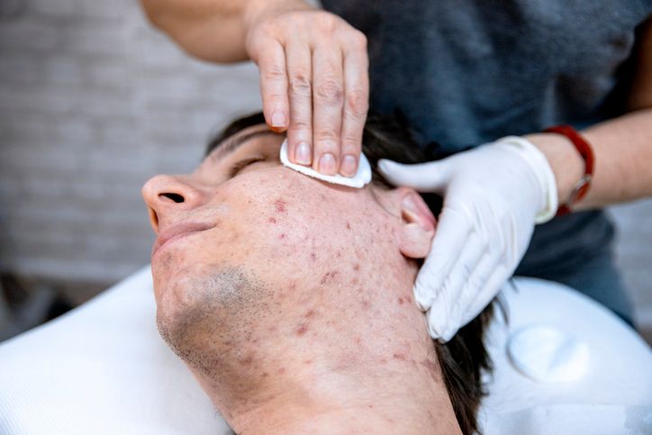 our-ultimate-acne-scars-guide-is-for-you-if-you-are-looking-for-the