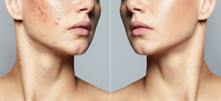 our-ultimate-acne-scars-guide-is-for-you-if-you-are-looking-for-the