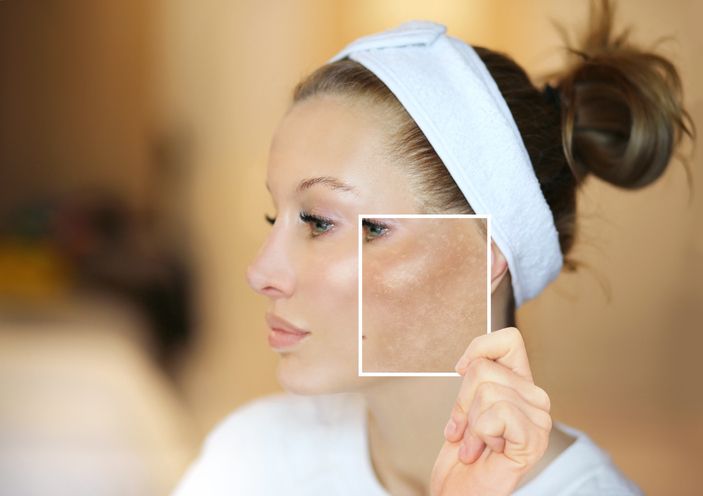 How to Choose the Right Hyperpigmentation Treatment for Your Skin Types!
