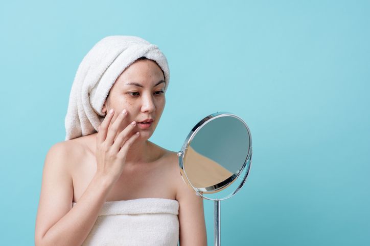 Exploring the Causes and Symptoms of Hyperpigmentation!
